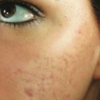 Acne Scars - Before