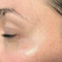 Pigmentation and Spots - After