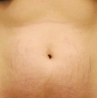 Stretch Marks - After