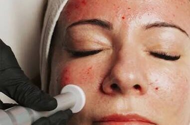 Personalised Skin Treatments on the Fraser Coast: Tailored Plans, Real Results