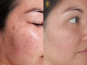 Personalised Skincare Consultations on the Fraser Coast: Your Shortcut to Confident, Healthy Skin